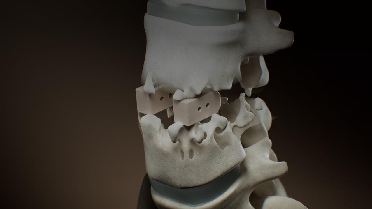 spinal_cage_header