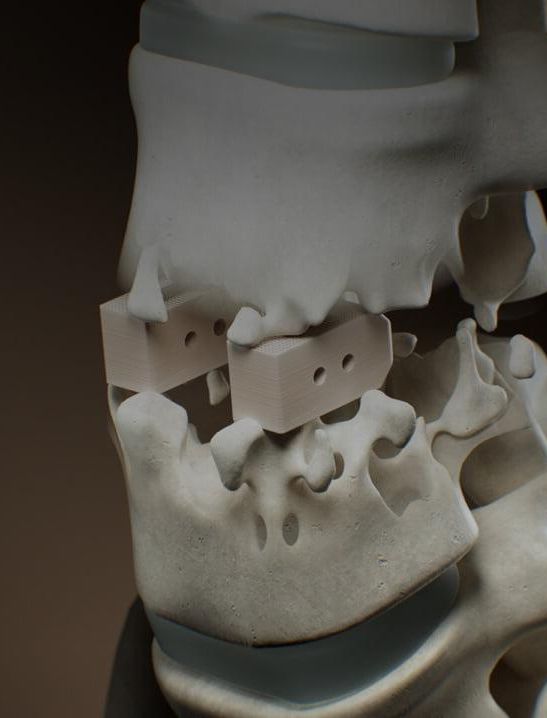 spinal_cage_header